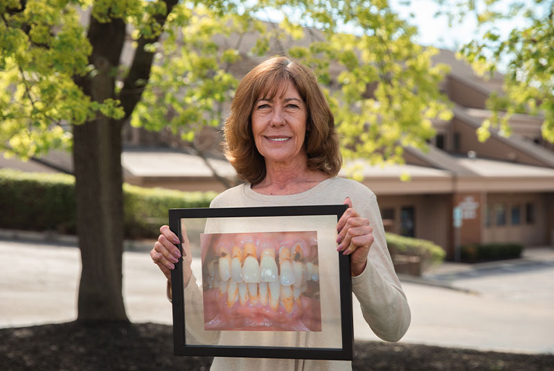 becky - dental implants patient